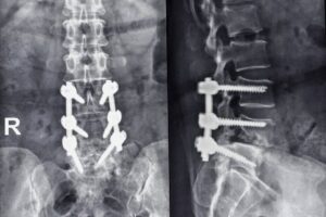 X-ray_of_the_human_Lumbar_w-screws