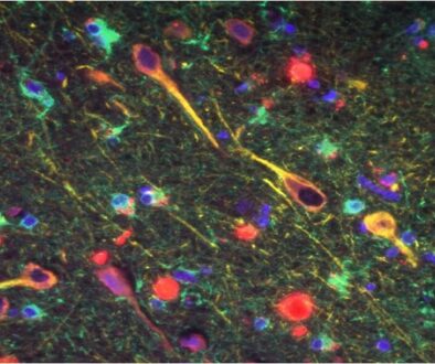 530-alzheimers-gum-disease-bacteria-1