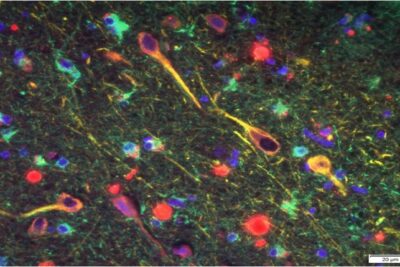 530-alzheimers-gum-disease-bacteria-1