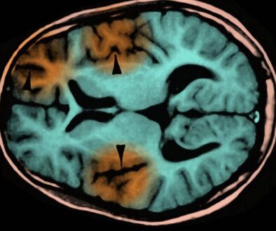 subacute_sclerosing_panencephalitis_mri
