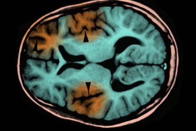 subacute_sclerosing_panencephalitis_mri