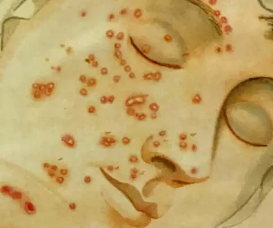 smallpox-face-illustration