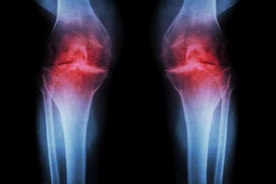 Osteoarthritis-Knee