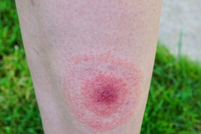 CIA accused of secret bioweapon experiments linked to major outbreak in its own people Daily Mail Online