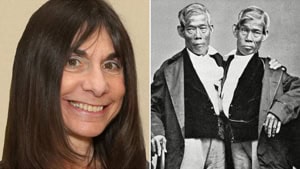 Chang and Eng Bunker: conjoined twins