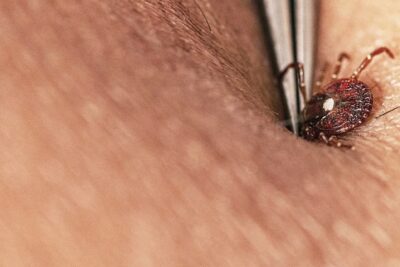 How to avoid tick bites in your yard or while hiking in the woods, and what to do if one starts feasting on you