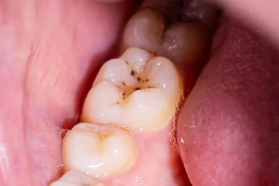 Goodbye, cavities? New gel could regrow tooth enamel