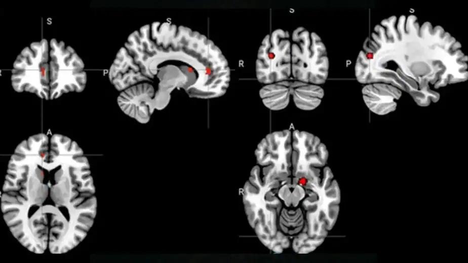 Acupuncture Seems to Rewire The Brain in Depression, Scans Reveal